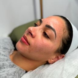 Mesotherapy Skin Treatment in London