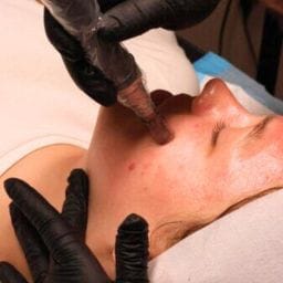 Services 31 microneedling with